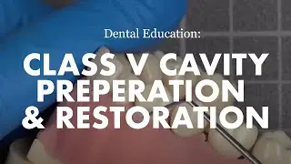Class V cavity preparation and restoration