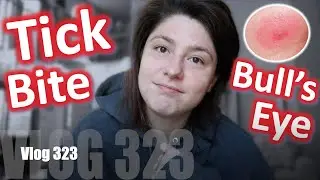 Ch.323: My New Tick Bite & Bull&rsquo;s Eye Rash + Treatment I&rsquo;ve Undergone Since The End Of May