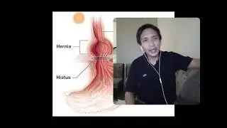 Release Hiatal Hernia & relieve from GERD,self adjustment EXERCISE