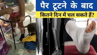 🦵🦶पैर टूटने के बाद कितने दिन में चल सकते है, pair ka fracture kitne din me thik hota hai, exercises