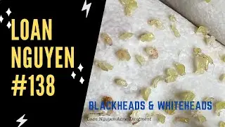 REMOVAL ACNE as the rice is delicious, so ammazing (138) | Loan Nguyen