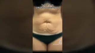 Tummy Tuck Transformation