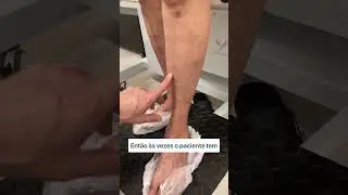 VARIZES NAS PERNAS