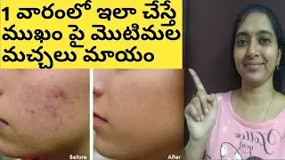 How To Remove Pimples Marks From Face Naturally In Telugu/How To Remove Pimples Marks At Home Telugu