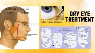 Dry eyes treatment , 20-20-20 rule , Surgery for dry eyes & Medicine for dry eyes