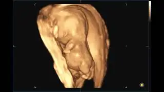 Prenatal Diagnosis of Lethal Skeletal Dysplasia Fetal Antenatal Ultrasound 