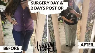 Tummy Tuck & Thigh Lift after WLS | Pre-Op, Surgery Day and 2 days Post Op!