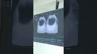 Video prostat
