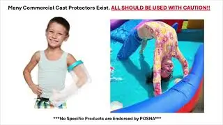 Cast Care FAQs - Taking Care of a Cast