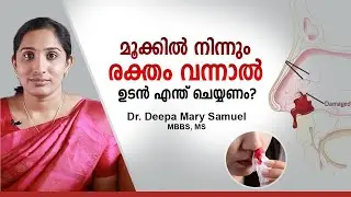 Nosebleed Causes & First Aid | What to Do When Blood Comes From the Nose