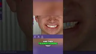 Prepless Veneers with CEREC: Advanced Techniques Revealed! #shorts