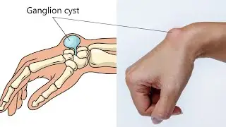 Ganglion Cyst Exercises | Wrist Routine: Handstand, Planche + Bulletproof Wrist.