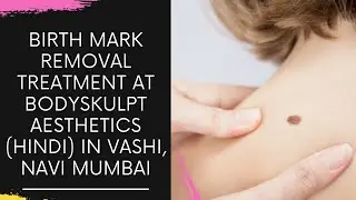 BIRTH MARK REMOVAL TREATMENT AT BODYSKULPT AESTHETICS (HINDI) IN VASHI, NAVI MUMBAI