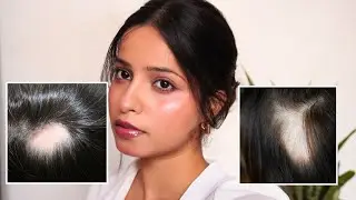How I Recovered from Stress Baldness  My Hair Regrowth Journey 🌱