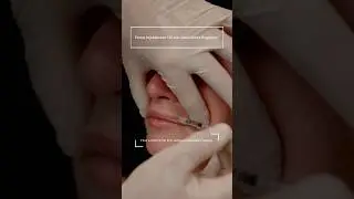 Mehr Oberlippe beim L&auml;cheln &ndash; dank Lip Flip