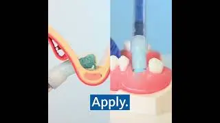 Geistlich Bio Oss Pen&reg; u 3 koraka!