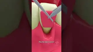 Fixing Receding Gums #shorts  #dentalcare - Creativelearning3d