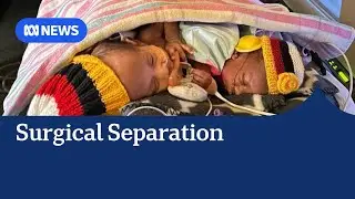One of PNG's conjoined twins dies after surgical separation | ABC NEWS