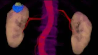 Incidental renal cell carcinoma