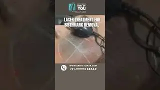 Laser Treatment for Birthmark Removal| Birthmark Removal Treatment in Delhi | Dr. PK Talwar