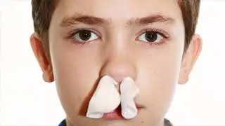 Role Of Nasal Packs For Nose Bleeding People- What Are The Doctors Suggestions