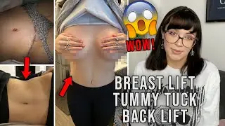 MY PLASTIC SURGERY SCARS! Breast lift, tummy tuck, & back lift.