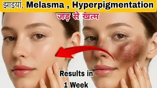 7 दिन में गायब 10 साल पुरानी झाइयां | How to remove Pigmentation & darksopts at home #diy  #skincare