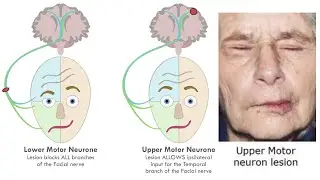 ACUPUNCTURE FOR UPPER MOTOR NEURON PARALYSIS