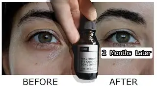 NIOD Fractionated Eye Contour Concentrate Before and After | Two Month Review