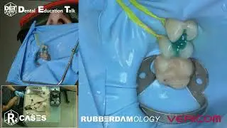 Травление тканей зуба #Rubberdamology #Vericom #Etching Case 07 #8kdcv #8K