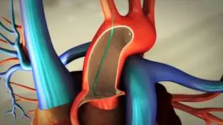 Transradial catheterization and coronary artery cannulation