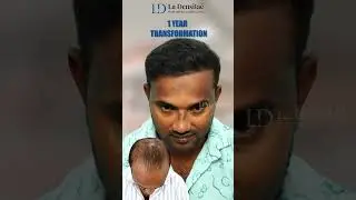 Hair Transplant Shocking Result
