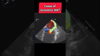 What's Causing this type of Mitral Regurgitation #shorts #viral