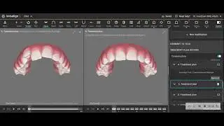 Invisalign First Maxillary Arch Expansion