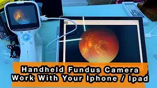 Handheld Fundus Retinal Camera Connect With Your Iphone/Ipad