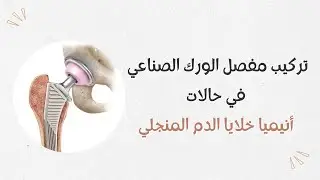مفصل الورك الصناعي: تركيب مفصل فخذ صناعي فى حالات مرضى أنيميا خلايا الدم المنجلية