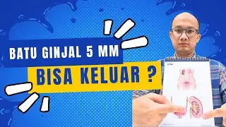 Batu ginjal 5 mm bisa keluar sendiri? Apakah batu ginjal ini berbahaya? -