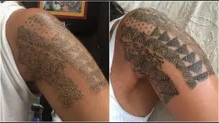 MINHA REMOÇÃO DE TATUAGEM - DETALHES!