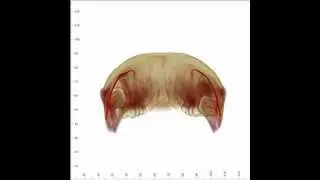 Impacted Third Molars with Cysts - 3D Cone Beam CT Scan and Animation by SmartScan Imaging of Orange
