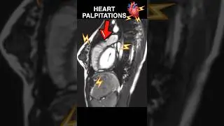 Heart PALPITATIONS under MRI🫀⚡️ #anxiety #cardiology
