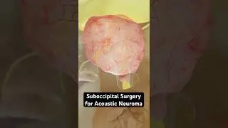 Removing a tumor from your ear (3D Animation)