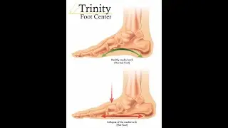Do you actually have flat feet?