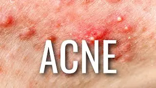 The REAL Reasons You Have Acne
