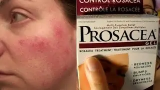 Prosacea Rosacea Treatment Product Review (not sponsored) | Rosy JulieBC