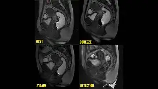 MRI DEFECOGRAPHY  #mriscan #viralvideo