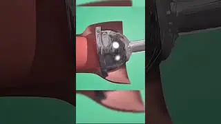 Ever wonder how B clamp circumcision works? #shorts #medical