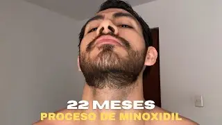 22 MESES USANDO MINOXIDIL PARA CRECER BARBA (SIENDO 100% LAMPIÑO)