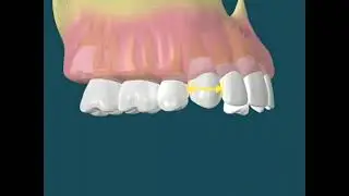 Dental Video for Serial Extraction - The Tooth