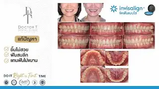 Before - After 𝗜𝗻𝘃𝗶𝘀𝗮𝗹𝗶𝗴𝗻 แก้ปัญหายิ้มไม่สวย ฟันสบลึก แกนฟันไม่ขนาน
