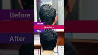 ✨ Otoplasty (Ear Reshaping) Before & After | Dr. Habib's Amazing Results! 🌟